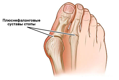 Вальгусная деформация первого пальца стопы