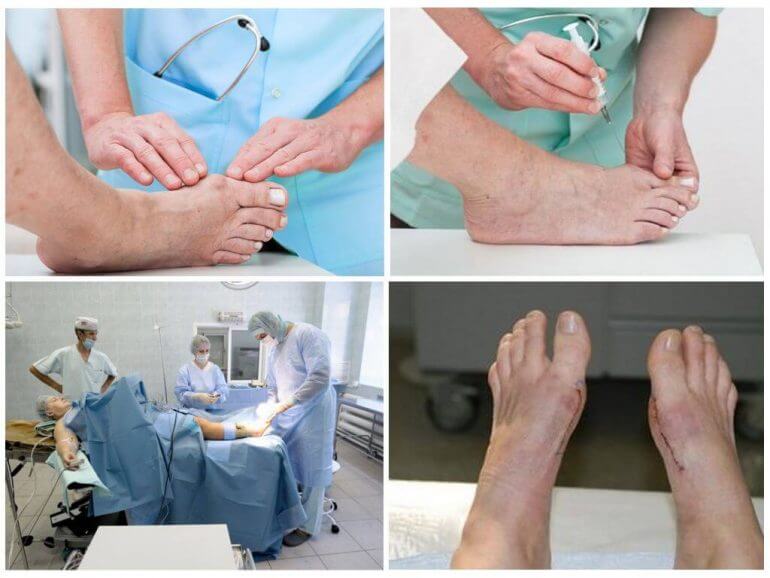 Операционная коррекция вальгусной деформации стопы