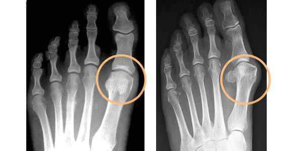 Ренгенограмма стопы при вальгусной деформация первого пальца 